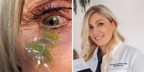 Eye Spy A Big Problem California Doctor Removes 23 Contact Lenses From