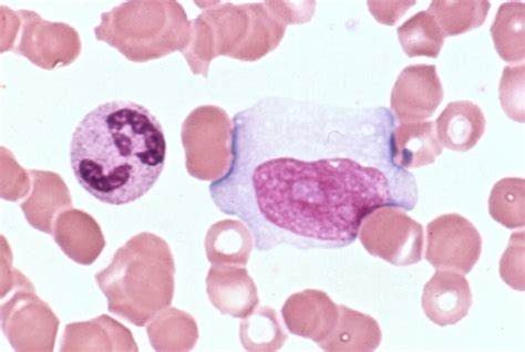 How To Identify Lymphocytes In A Blood Smear Pathology Student