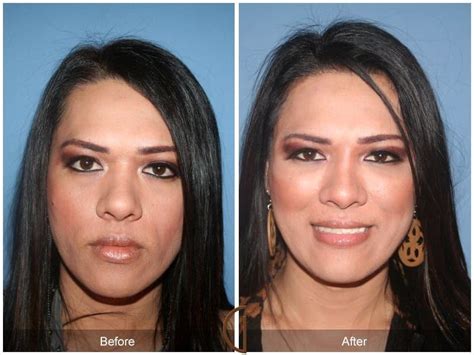 Facial Fat Grafting Before And After Photos Patient 01 Dr Kevin Sadati
