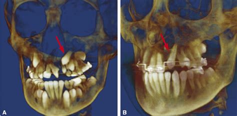 Volume Rendering Of Cbct Scans Of An Individual With A Unilateral Cleft