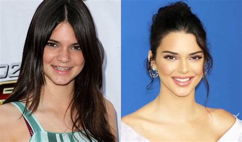 celebs transformed by braces 10 before and afters