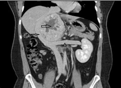 Cureus Huge Right Retroperitoneal Paraganglioma With A High Risk Of
