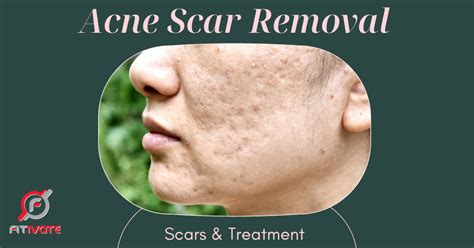 Acne Scar Removal In Singapore Scars And Treatments