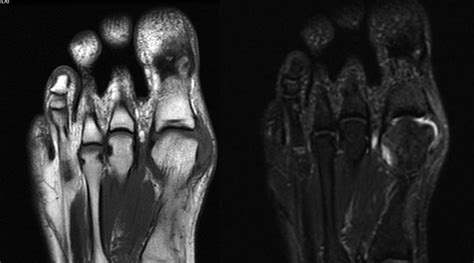 Post Traumatic Hallux Valgus A Rupture Of The Medial Collateral