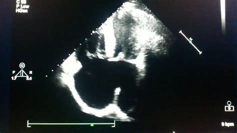 Echocardiogram Ostium Primum Atrial Septal Defect Youtube