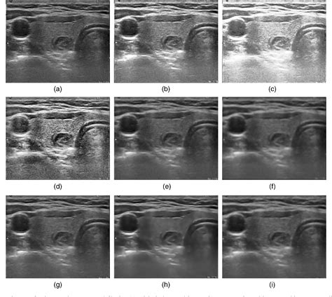 Some Examples Of Benign And Malignant Thyroid Nodules In Ultrasound
