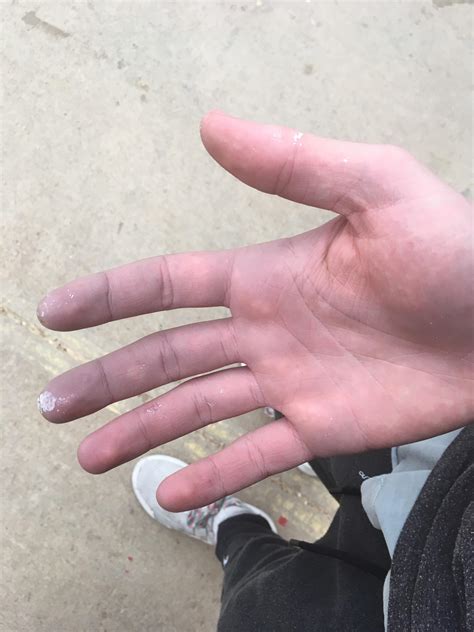 My Friends Hands Turn Purple When It Gets Cold Out Rmildlyinteresting