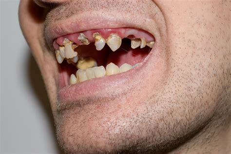 虫歯の多い子はネグレクトのsosかも 八潮の歯医者 Lealea歯科・矯正歯科クリニック