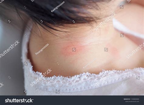 Baby Skin Rash Allergy Red Spot Stock Photo 1150983005 Shutterstock