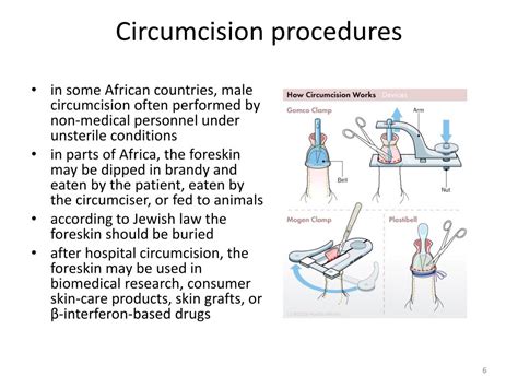 Ppt Circumcision And Vasectomy Powerpoint Presentation Free Download Id 1457116