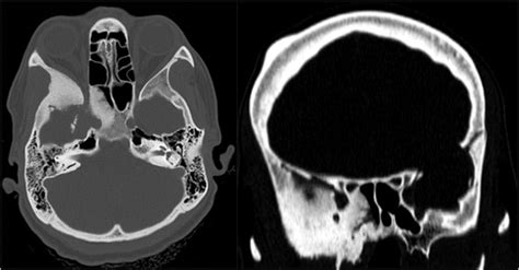 Preoperative Thin Bone Window Ct Section Of An Internal Som Variety