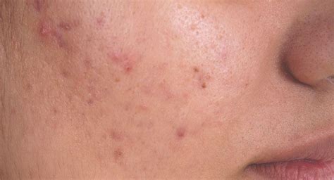 Boil Vs Pimple Tips For Identification Skin Boil Pimples Natural