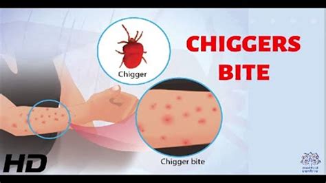 What Is The Difference Between Chiggers And Bed Bugs Archive EN