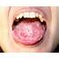 Fissured Tongue Archives  Salvaggio Dentistry Blog