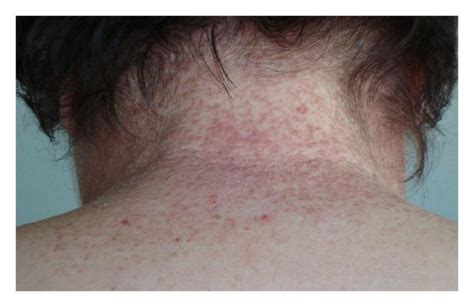 Clinical Manifestations Of The Disease With Keratotic Papules A