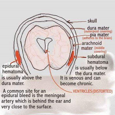 These tests allow your doctor to see where the blood is coming from and to find any other injuries. Subarachnoid Hemorrhage vs Subdural Hematoma | Dear Nurses ...