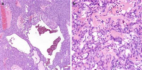 Benign Tumors Of The Lung In Small Lung Biopsies Thoracic Key
