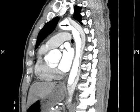Aortic Dissection Ct Scan