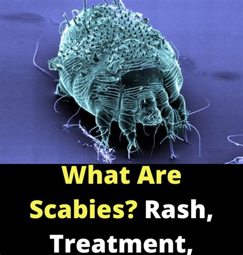 What Are Scabies Rash Treatment Symptoms Pictures
