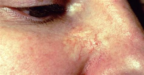 Morpheaform Basal Cell Carcinoma Pictures Symptoms Causes Prognosis