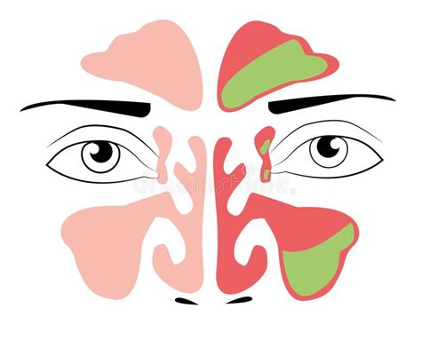 Sinusitis Symptoms Icons Nasal Diseases Sinusitis Sinus Infection