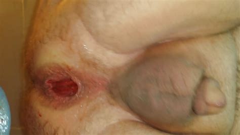 Anal Gape From Prostate Milking 26 Pics Xhamster