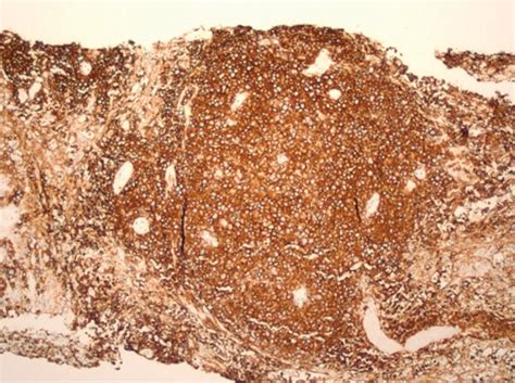 Primary Mediastinal Large B Cell Lymphoma A Review For Radiologists Ajr