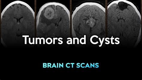 Tumors And Cysts Brain Ct Scans Of Different Conditions Youtube