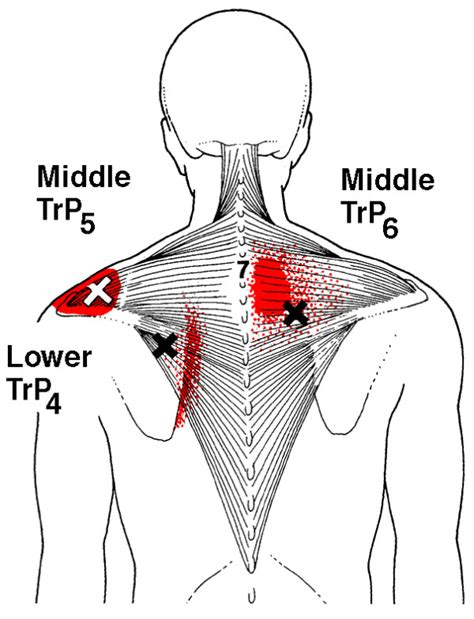 Referred Pain Patterns Red From The Upper And Middle Trapezius Muscle
