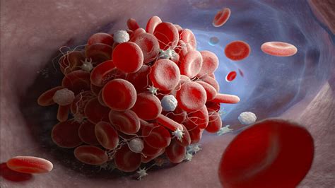 How Covid 19 May Trigger Dangerous Blood Clots