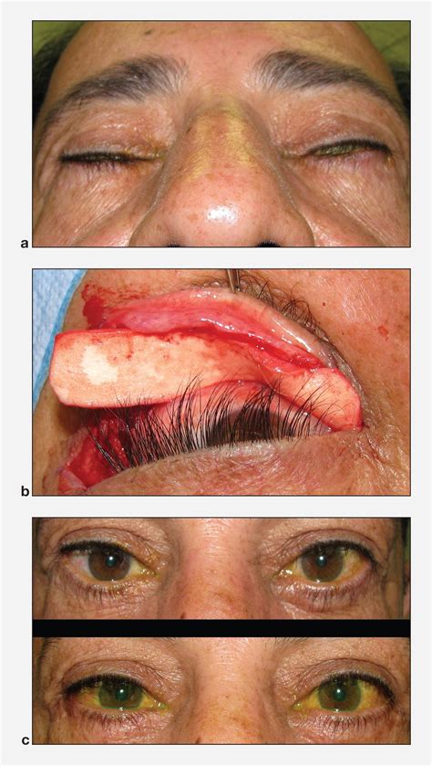 Repair of lagophthalmos - American Academy of Ophthalmology
