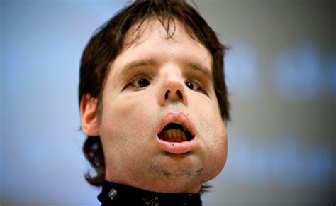 Recipient Of First Ever Full Face Transplant Appears In Public For The
