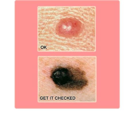 What Cancerous Moles Melanoma Look Like
