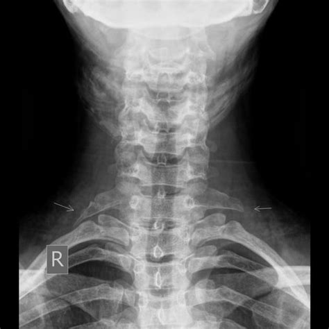 Cervical Ribs Radiology Case Cervical Ribs