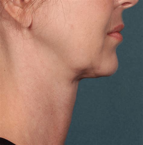 Kybella™ Treatment Of Submental Fullness Double Chin Skincare