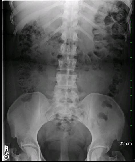 Archive Of Unremarkable Radiological Studies Abdominal X Ray Kub
