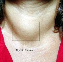 Image result for Thyroid Cancer Nodules