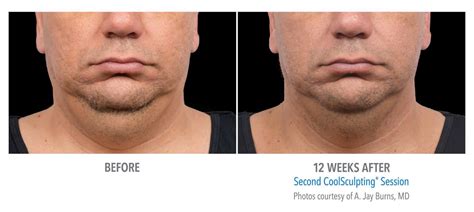 Double Chin Reduction Atlanta Coolsculpting Chin Sculpted Contours