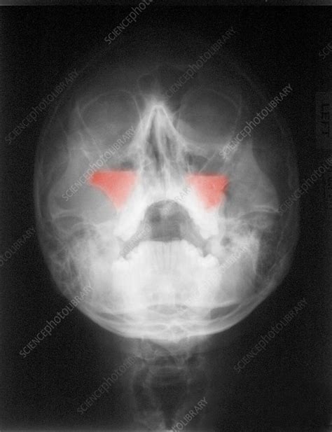 Maxillary Fracture X Rays