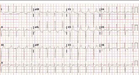 Figure 1 From Pr Interval Prolongation In A Patient With Infective