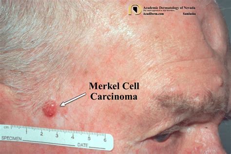 Merkel Cell Carcinoma Murky Cell Carcinoma Academic Dermatology