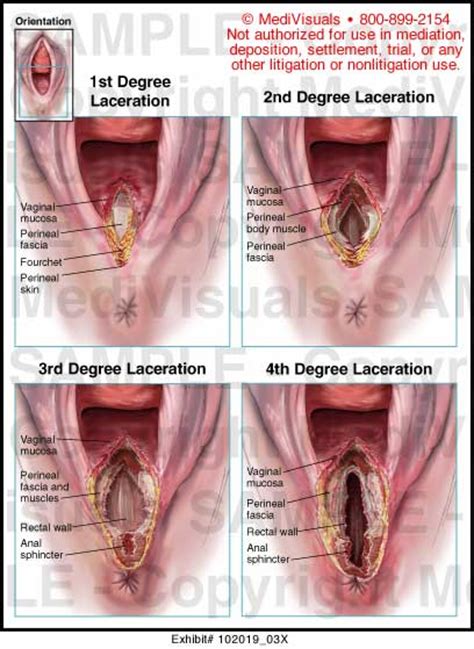 Episiotomy Extensions Medical Illustration Medivisuals