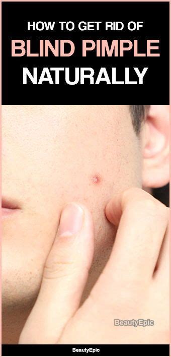 13 Easy Ways To Get Rid Of Blind Pimple Fast Blind Pimple Pimples