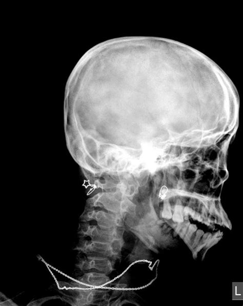 Free A Schedel Ap Radiograph Of The Skull Head And Neck Xray