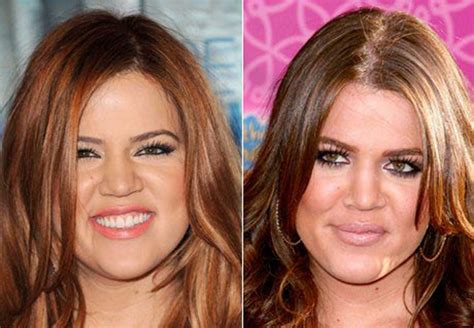 Khloe Kardashian Nose Job Plastic Surgery Before And After Celebie