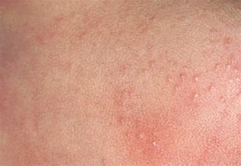 Gallery For Baby Skin Heat Rash