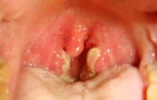 The Gallery For White Spots Tonsils Cancer