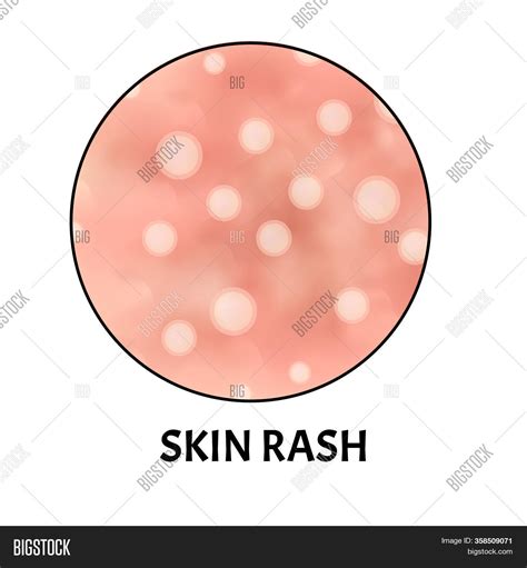 Skin Rash Symptom Image And Photo Free Trial Bigstock