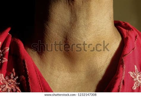 Anterior Neck Swelling Goitre Stock Photo 1232147308 Shutterstock