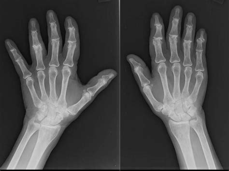 A Patients Guide To Osteoarthritis Of The Hand Hand And Upper Limb Clinic